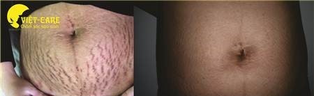 Rạn da là vấn đề thường gặp phải ở các chị em phụ nữ mang thai và sau sinh